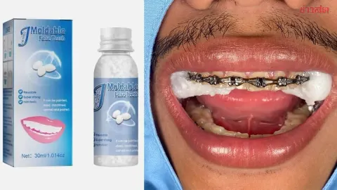 Dental Clinic Warns Against DIY Silicone Mouthguard After Patient Stuck