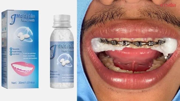 Dental Clinic Warns Against DIY Silicone Mouthguard After Patient Stuck