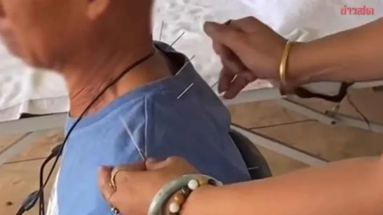 Phayao Health Office Investigates Acupuncture Clip Over Safety Fears
