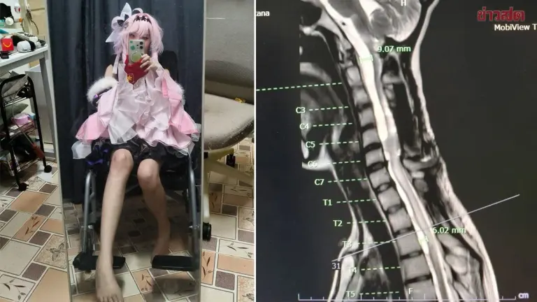 Thai Woman Shares Battle with Rare Disease to Inspire Others