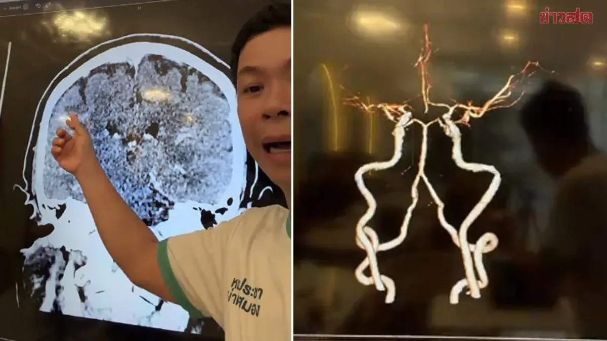 Neurosurgeon Warns Forgetting Names Could Signal Brain Vessel Narrowing